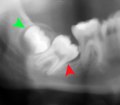 x-ray-impacted-wisdom-tooth
